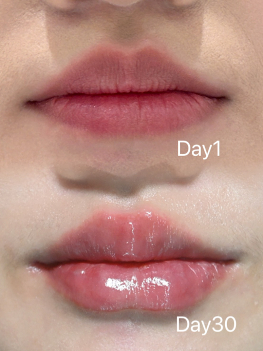 玻尿酸施作前後對比